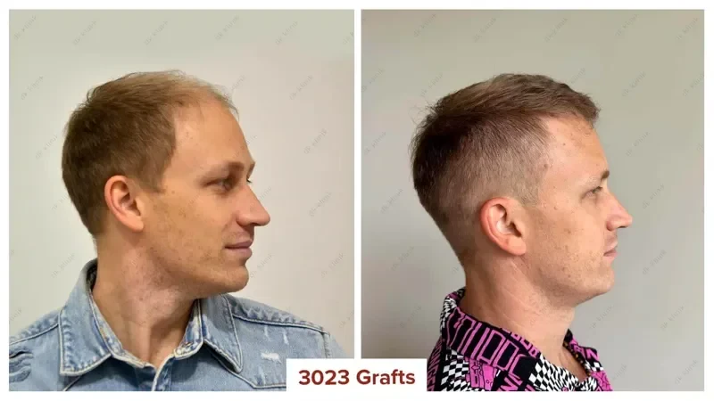 Hair-Transplant-Turkey-Before-After-3000-Grafts-2