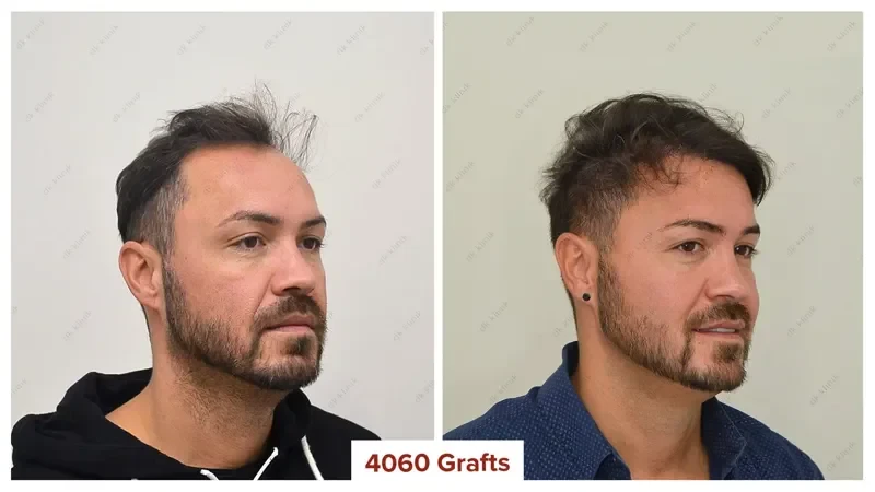 Hair-Transplant-Turkey-Before-After-4100-Grafts