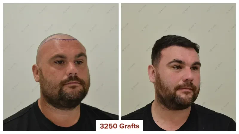 Hair-Transplant-Turkey-Before-After-3250-Grafts