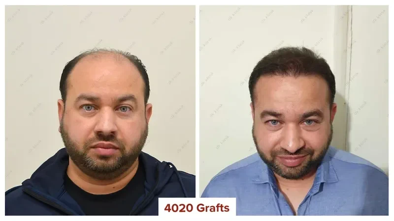 Hair-Transplant-Turkey-Before-After-4000-Grafts-3