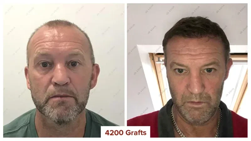 Hair-Transplant-Turkey-Before-After-4200-Grafts-2