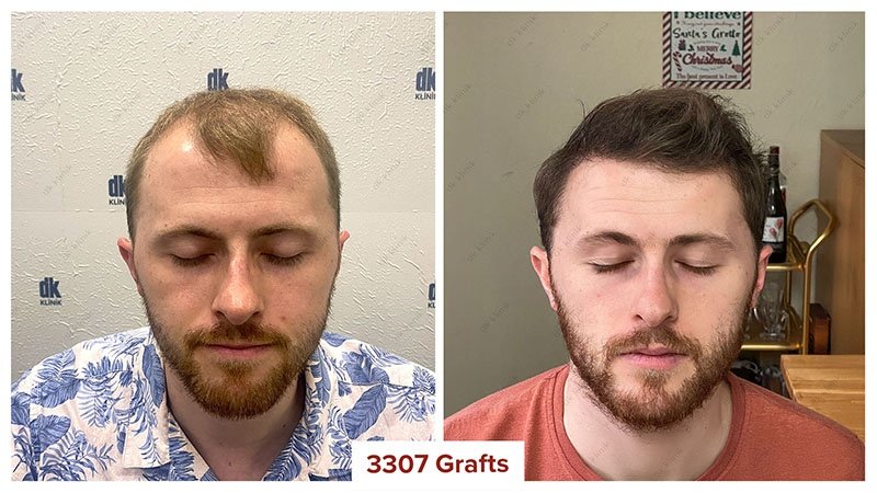 Hair-Transplant-Turkey-Before-After-3300-Graft-7