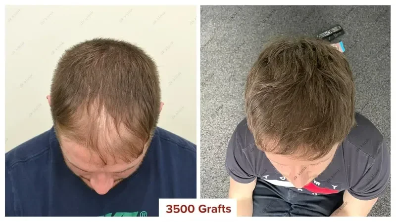 Hair-Transplant-Turkey-Before-After-3500-Grafts-2