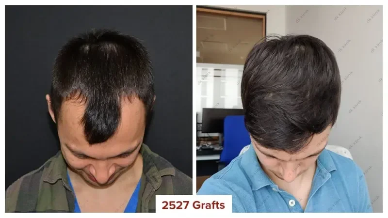 Hair-Transplant-Turkey-Before-After-2500-Grafts-1