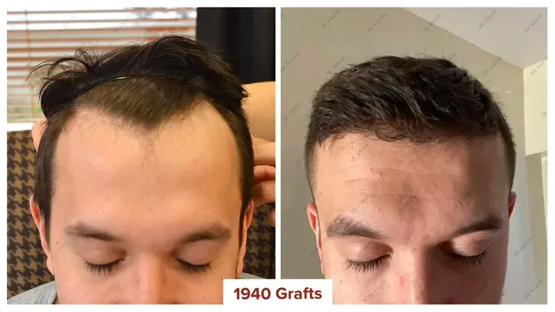 Hair-Transplant-Turkey-Before-After-1900-Grafts