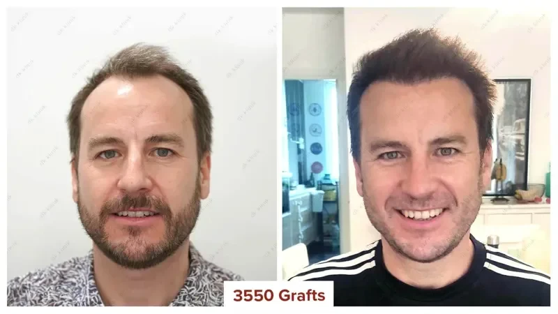 Hair-Transplant-Turkey-Before-After-3550-Grafts