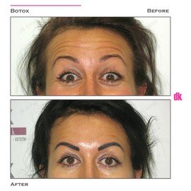 BOTOX - Forehead- Before and After