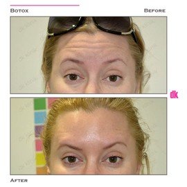 BOTOX - Forehead- Before and After