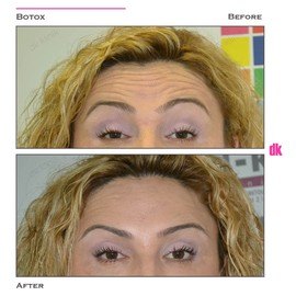 BOTOX - Forehead- Before and After