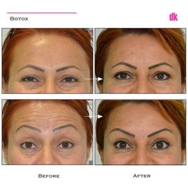 BOTOX - Forehead- Before and After