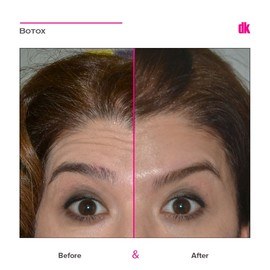 BOTOX - Forehead- Before and After