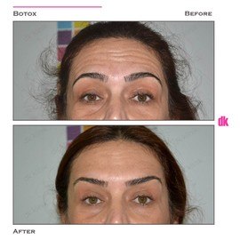 BOTOX - Forehead- Before and After