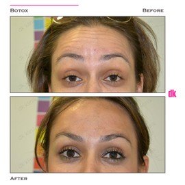 BOTOX - Forehead- Before and After