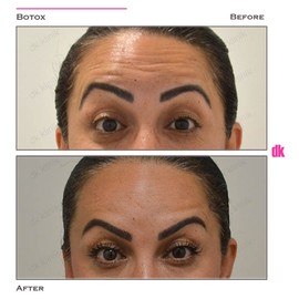 BOTOX - Forehead- Before and After