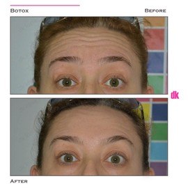 BOTOX - Forehead- Before and After