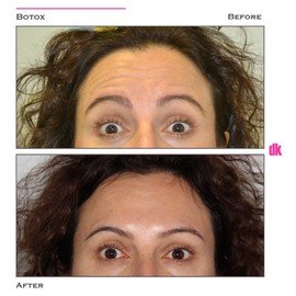 BOTOX - Forehead- Before and After