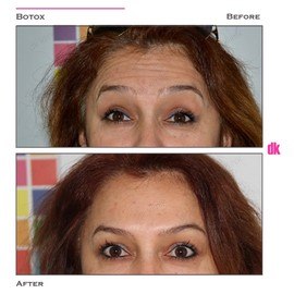 BOTOX - Forehead- Before and After