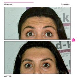 BOTOX - Forehead- Before and After
