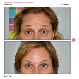 BOTOX - Forehead- Before and After
