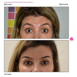 BOTOX - Forehead- Before and After