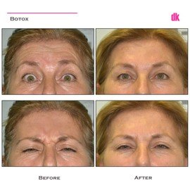 BOTOX - Forehead- Before and After