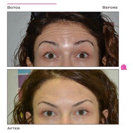 BOTOX - Forehead- Before and After