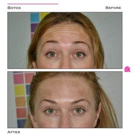 BOTOX - Forehead- Before and After