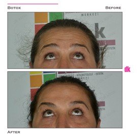 BOTOX - Forehead- Before and After