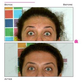 BOTOX - Forehead- Before and After