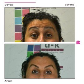 BOTOX - Forehead- Before and After