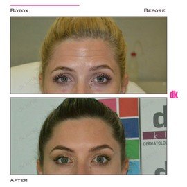 BOTOX - Forehead- Before and After