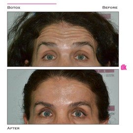 BOTOX - Forehead- Before and After