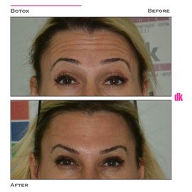 BOTOX - Forehead- Before and After