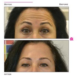 BOTOX - Forehead- Before and After