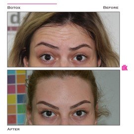 BOTOX - Forehead- Before and After