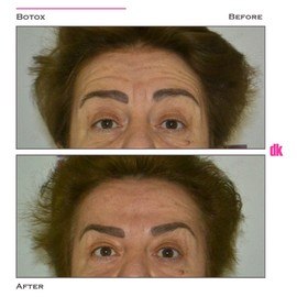 BOTOX - Forehead- Before and After