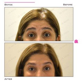 BOTOX - Forehead- Before and After