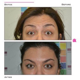 BOTOX - Forehead- Before and After