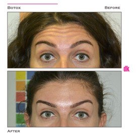BOTOX - Forehead- Before and After