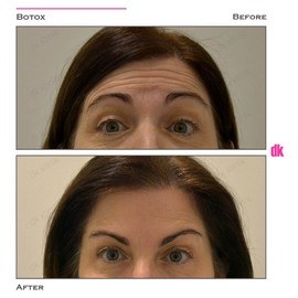 BOTOX - Forehead- Before and After