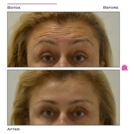 BOTOX - Forehead- Before and After