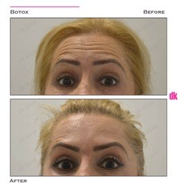 BOTOX - Forehead- Before and After