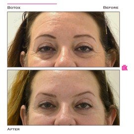 BOTOX - Forehead- Before and After