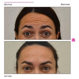 BOTOX - Forehead- Before and After