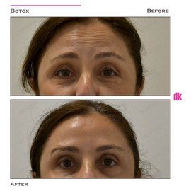BOTOX - Forehead- Before and After