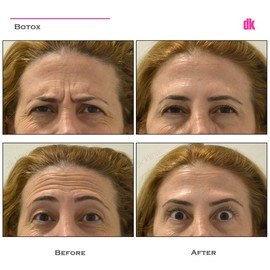 BOTOX - Forehead- Before and After