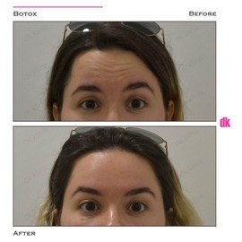 BOTOX - Forehead- Before and After