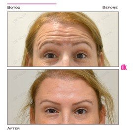 BOTOX - Forehead- Before and After