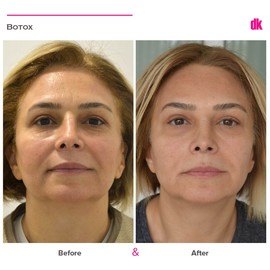 BOTOX - Forehead- Before and After