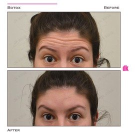 BOTOX - Forehead- Before and After